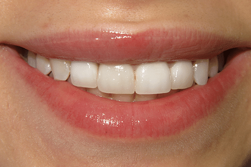 Maya After Procedure Teeth