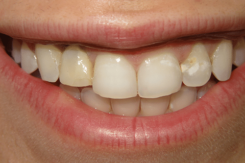 Maya Before Procedure Teeth