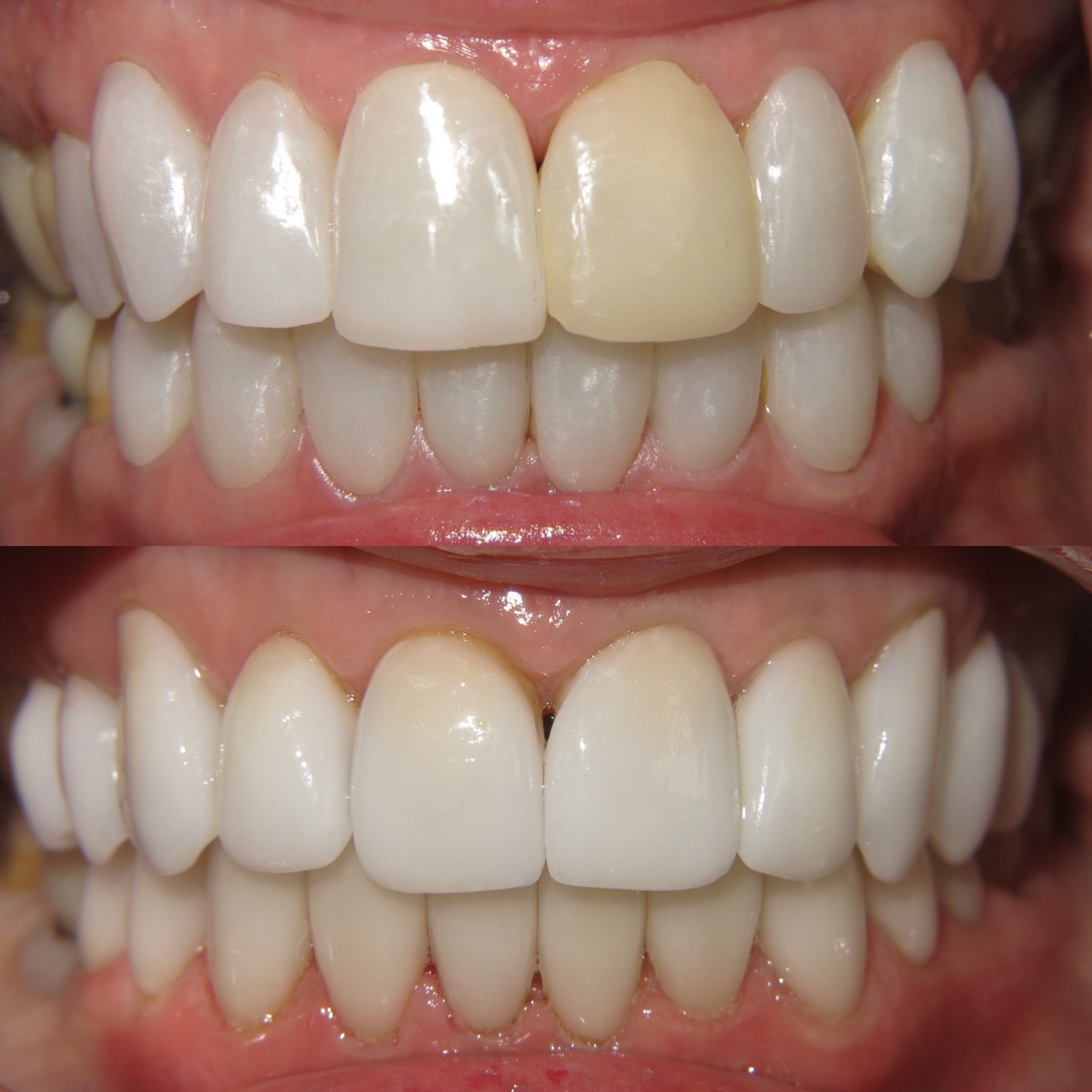 How Well Does LED Teeth Whitening Work