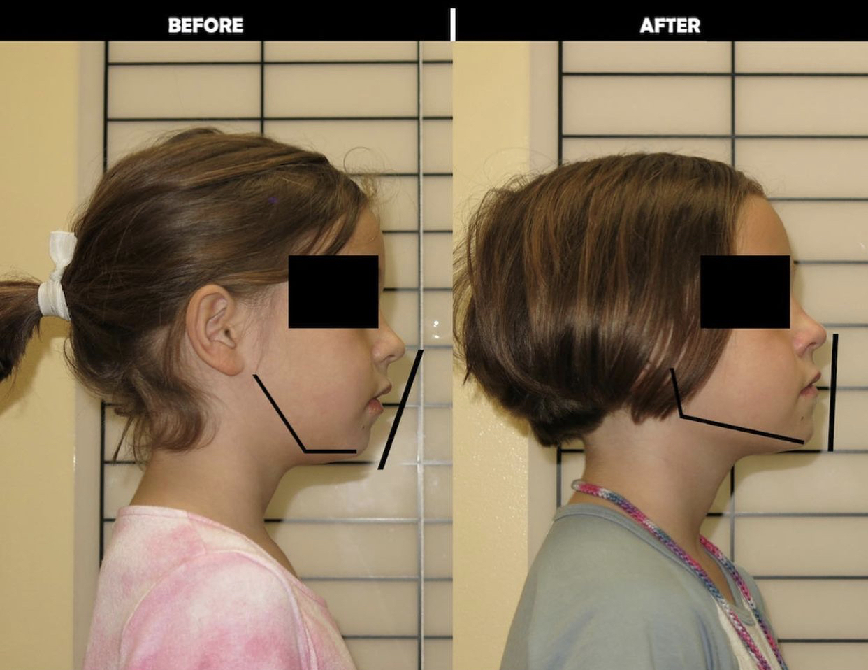 Myobrace in Burke, VA | Straight Teeth Without Braces